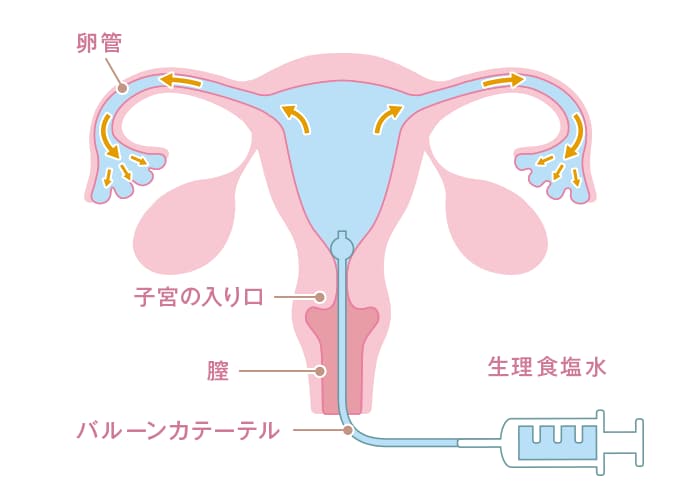 卵管通水検査