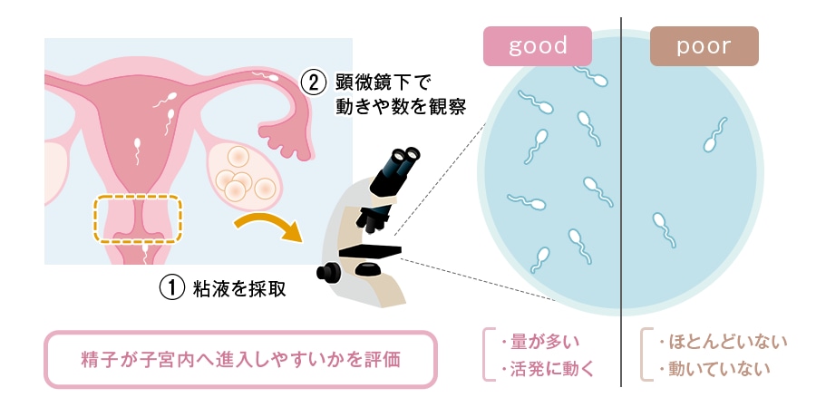 フーナー検査