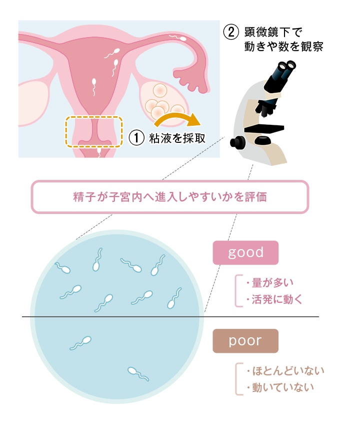 フーナー検査