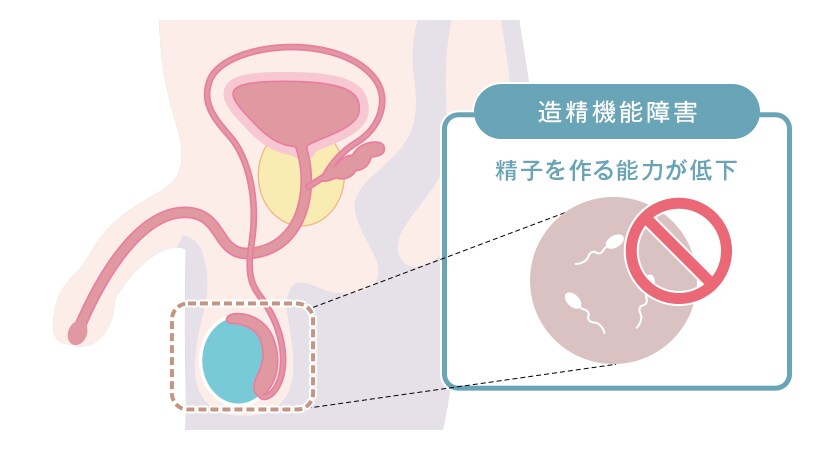男性不妊の原因