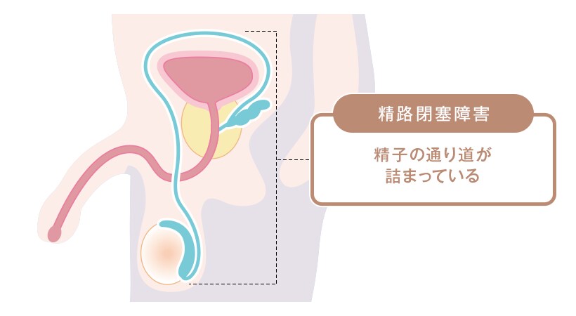 男性不妊の原因
