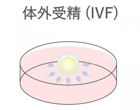 体外受精(IVF)