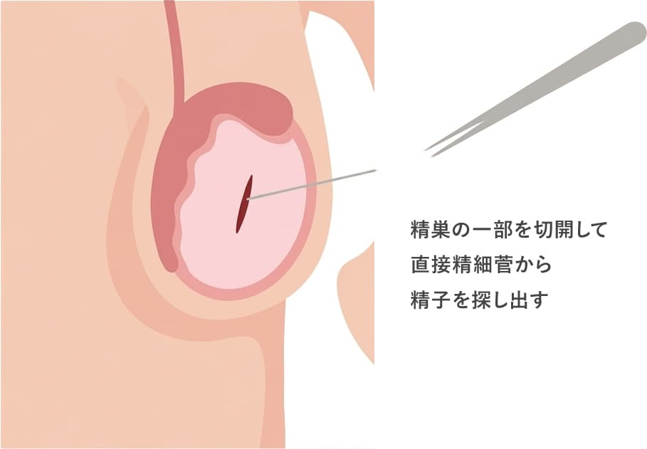 精巣内精子による顕微授精(TESE-ICSI)