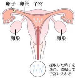 人工授精